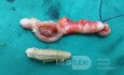 L'appendicite - l'infection provoquée par une obstruction de la lumière de l'appendice. 2