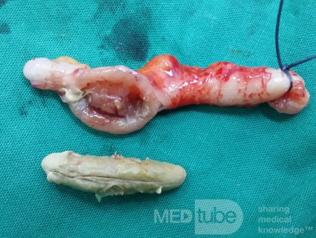 L'appendicite - l'infection provoquée par une obstruction de la lumière de l'appendice. 2