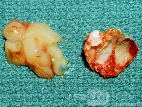 Mucus de l'intérieur de concha bullosa [échantillon chirurgical]