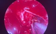 Résection Endoscopique de Microadénome Hypophysaire Responsable d'Acromégalie : un Défi au Niveau de la Paroi Caverneuse Médiale