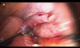 Dissection de Masse Appendiculaire
