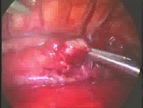 Atrésie de l'œsophage avec fistule trachéo-œsophagienne distale chez le nouveau-né - traitement thoracoscopique
