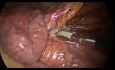 Colectomie partielle laparoscopique 