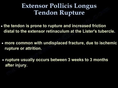 Rupture du tendon extenseur du pouce long