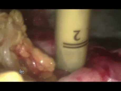 Traitement laparoscopique d un kyste hydatique du foie