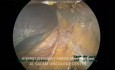 Adrénalectomie gauche par laparoscopie, étape par étape