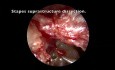Tympanoplastie Endoscopique Transcanalaire PORP pour Malformation de la Chaîne Ossiculaire