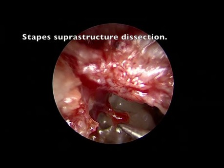 Tympanoplastie Endoscopique Transcanalaire PORP pour Malformation de la Chaîne Ossiculaire