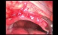 Réparation d'une hernie diaphragmatique gauche avec un filet par laparoscopie chez un patient atteint de volvulus gastrique