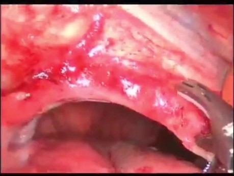 Réparation d'une hernie diaphragmatique gauche avec un filet par laparoscopie chez un patient atteint de volvulus gastrique