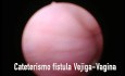 Fistule Vésico-vaginale. Fistulorraphie Laparoscopique. Correction Laparoscopique des Fistules Vésico-vaginales.