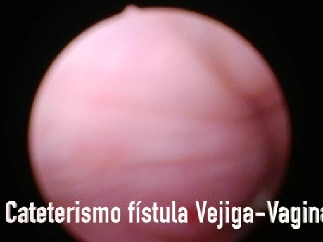 Fistule Vésico-vaginale. Fistulorraphie Laparoscopique. Correction Laparoscopique des Fistules Vésico-vaginales.