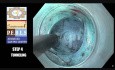 La myotomie per-oral endoscopique (POEM) - le traitement de l'achalasie (cardio-spasme)