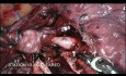 Lobectomie inférieure du poumon droit assistée par robot 