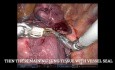 Segmentecomie Pulmonaire Complexe - S9+10 Gauche