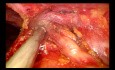 Thymectomie totale par chirurgie thoracique vidéo-assistée (CTVA) à l'incision unique sous-xiphoïde