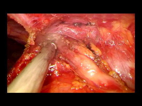 Thymectomie totale par chirurgie thoracique vidéo-assistée (CTVA) à l'incision unique sous-xiphoïde