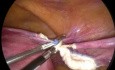 TLH, rupture de l'endobag