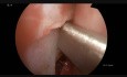 Septoplastie endoscopique et résection des polypes