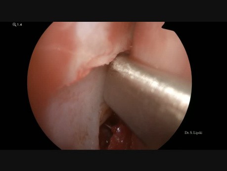 Septoplastie endoscopique et résection des polypes