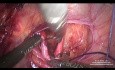 Dissection antérieure et ligature de l'artère utérine à son origine dans un grand utérus