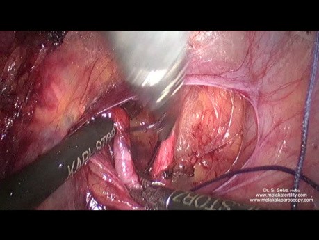 Dissection antérieure et ligature de l'artère utérine à son origine dans un grand utérus