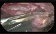 L'hystérectomie totale avec annexectomie bilatérale par voie laparoscopique