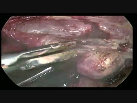 L'hystérectomie totale avec annexectomie bilatérale par voie laparoscopique