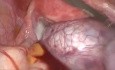 Cystectomie Paratubaire Laparoscopique avec Torsion Ovarienne