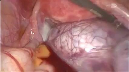 Cystectomie Paratubaire Laparoscopique avec Torsion Ovarienne