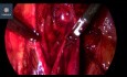 Infertilité - chirurgie de l'endométriose