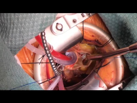 Remplacement valvulaire aortique par chirurgie mini-invasive à cause sténose aortique sévère.