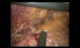 Gastrectomie totale avec curage ganglionnaire de type D2 par voie cœlioscopique chez un patient obèse (vidéo complète)