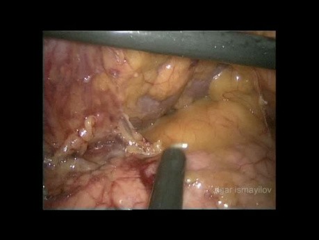 Gastrectomie totale avec curage ganglionnaire de type D2 par voie cœlioscopique chez un patient obèse (vidéo complète)