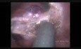 Exérèse trans-anale d'un polype rectal malin T1 par microchirurgie endoscopique (TEM)