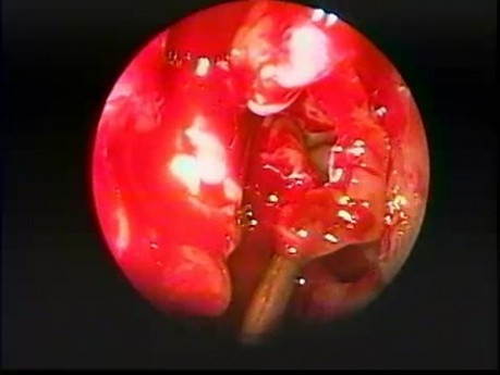 Déhiscence de l'os lacrymal - Endoscopie