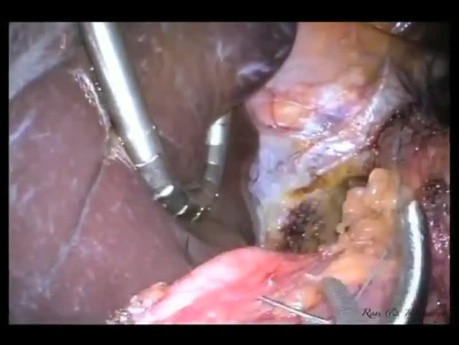 Fundoplicature de Nissen Laparo-Endoscopique à Site Unique (LESS)