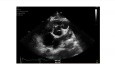 Cas Intéressant : un Jeune Immigrant aux Antécédents de Chirurgie Cardiaque et Présentant une Echographie Cardiaque Anormalec
