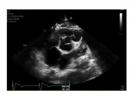 Cas Intéressant : un Jeune Immigrant aux Antécédents de Chirurgie Cardiaque et Présentant une Echographie Cardiaque Anormalec