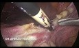 Hystérectomie laparoscopique totale (AUB, 3 C/S précédents)