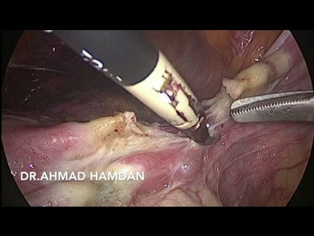 Hystérectomie laparoscopique totale (AUB, 3 C/S précédents)