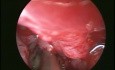 Pyocèle du sinus maxillaire