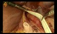 Procédure Heller-Dor laparoscopique