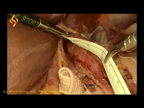 Procédure Heller-Dor laparoscopique