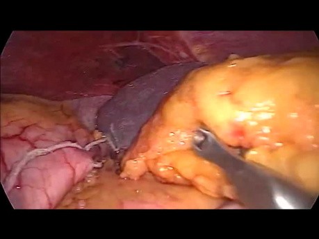 Gastrectomie en manchon par laparoscopie - première approche de l'estomac