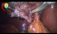 Dissection du canal cystique sous le sulcus de Rouvière et abord de la branche de l'artère cystique du canal cystique 