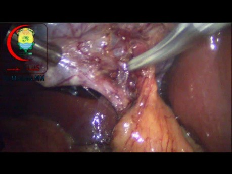 Dissection du canal cystique sous le sulcus de Rouvière et abord de la branche de l'artère cystique du canal cystique 