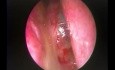 Kyste de cholestérol dans le septum nasal postérieur - ablation endoscopique