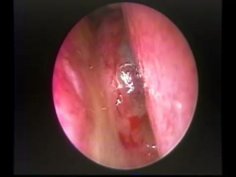 Kyste de cholestérol dans le septum nasal postérieur - ablation endoscopique