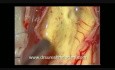 Tumeur de la Moelle Epinière - Intramédullaire Cervicale - Ablation Microchirurgicale